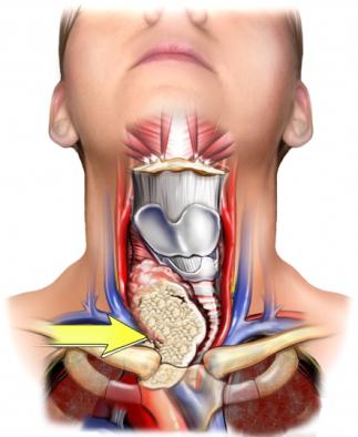 гипоплазия щитовидной железы у детей 10 лет