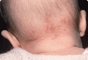 Потница на шее у ребенка 6 месяцев