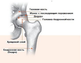 предвывих тазобедренного сустава у детей