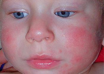 аллергия на рыбу у ребенка проявление