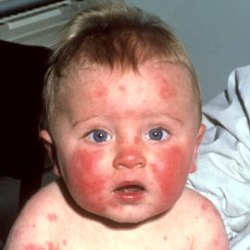 аллергия на шее у ребенка фото