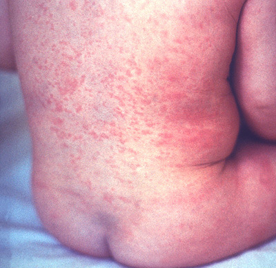 насморк у ребенка 5 месяцев комаровский