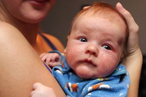 Аллергия у ребенка 9 месяцев чем лечить