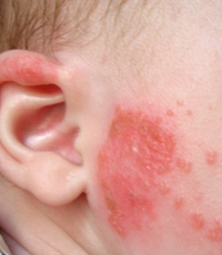 аллергия у ребенка 9 месяцев чем лечить