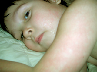 бактериальная инфекция у детей симптомы