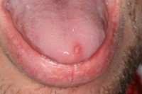 Болячки на языке у ребенка лечение
