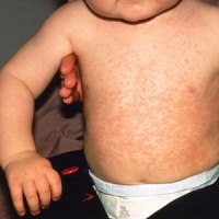 может ребенок заболеть краснухой после прививки
