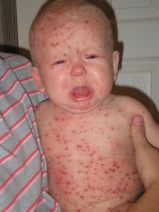 Может ребенок заболеть краснухой после прививки
