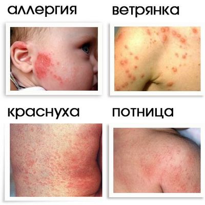 признаки гидроцефалии у ребенка 2 лет