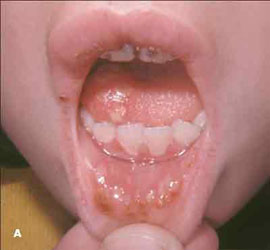 температура у ребенка на зубы что делать
