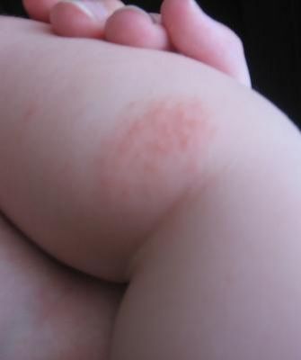 аллергия на ножках у ребенка комаровский