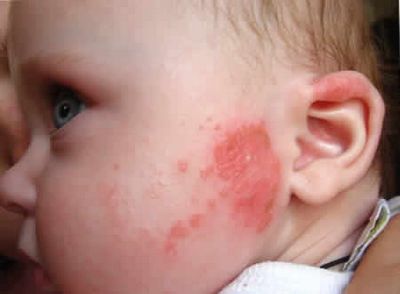 аллергия у маленьких детей комаровский