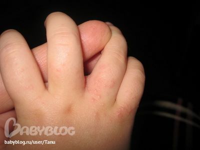 аллергия у ребенка на руках и ногах фото