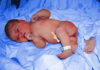 дети рожденные с гипоксией фото