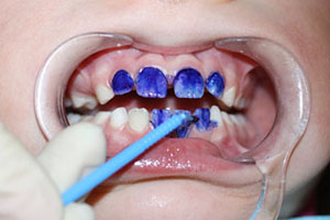 лечение зубов у детей в москве