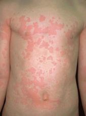 аллергический артрит у детей симптомы