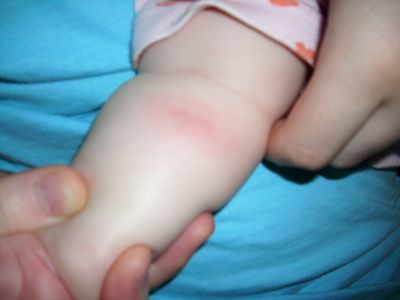 аллергия на гречку у ребенка