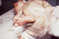 ангиопатия сетчатки у ребенка 1 год