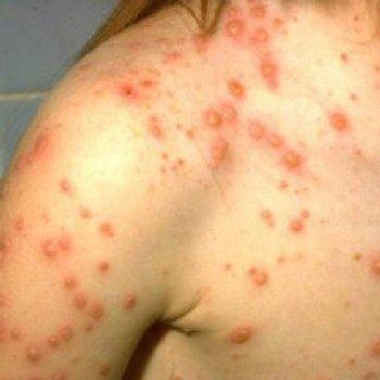 лечение гельминтов у детей комаровский