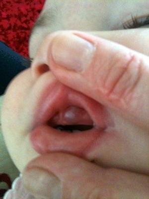 прорезывание зубов у детей фото десны