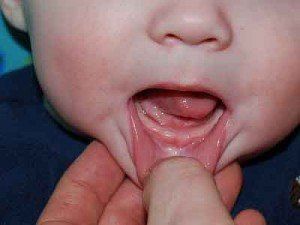 Прорезывание зубов у детей фото десны