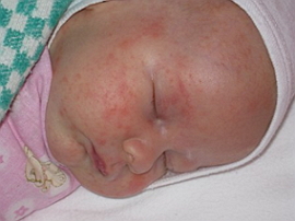 аллергия на сладкое у детей симптомы