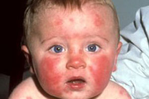 Аллергия у ребенка на лице чем лечить