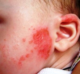 аллергия у ребенка на лице чем лечить