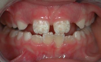 гипоплазия эмали зубов у детей лечение отзывы