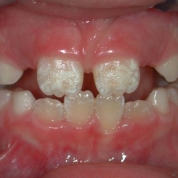 Гипоплазия эмали зубов у детей лечение отзывы