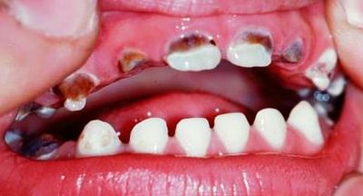 кариес постоянных зубов у детей фото