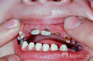 Кариес постоянных зубов у детей фото