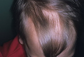 выпадение волос у детей 10 лет лечение