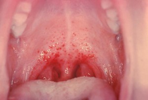Заболевания горла у детей симптомы