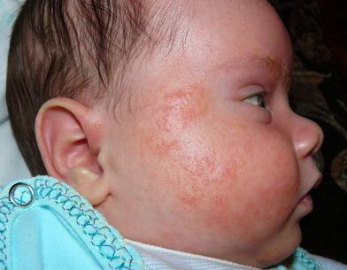 аллергия на энтерофурил у детей фото