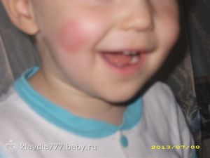 Аллергия на энтерофурил у детей фото