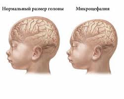 лечение неврологических заболеваний у детей