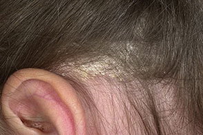 себорея волосистой части головы у детей лечение