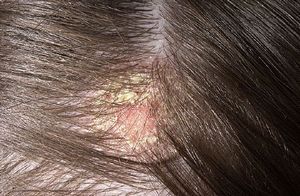 Себорея волосистой части головы у детей лечение