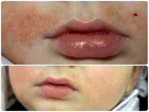 Аллергия на ацикловир у ребенка чем заменить