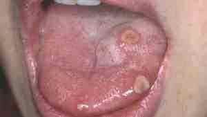 Аллергия на ацикловир у ребенка фото