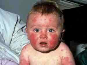 Аллергия на ацикловир у ребенка фото