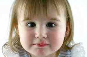 Герпес на губах лечение у детей ацикловиром