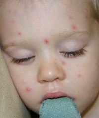 инфекционный менингит у детей симптомы