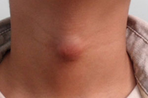 киста левой доли щитовидной железы у ребенка