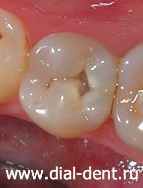 лечение зубов у детей видео