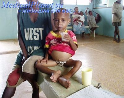 туберкулез легких у детей диагностика