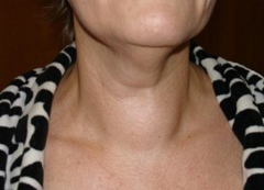 узловой зоб щитовидной железы у детей