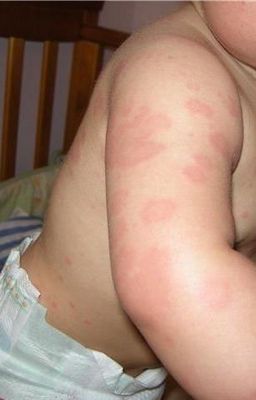 аллергия у ребенка 9 месяцев фото