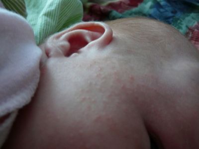 диатез у ребенка 5 месяцев